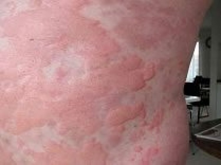 Κνίδωση δέρματος… Από αλλεργία ή άλλα αίτια;