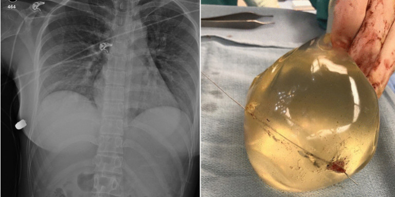 Σώθηκε από πυροβολισμό στο στήθος χάρη στα εμφυτεύματα σιλικόνης