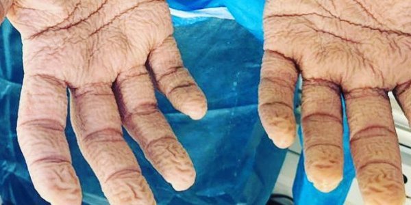 Κορωνοϊός: Τα ζαρωμένα χέρια νοσηλευτή μετά από 8 ώρες συνεχόμενων τεστ – Συγκλονιστική εικόνα