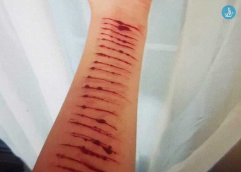 Το δράμα 12χρονης – Την ανάγκαζε να αυτοτραυματίζεται μέσω διαδικτύου