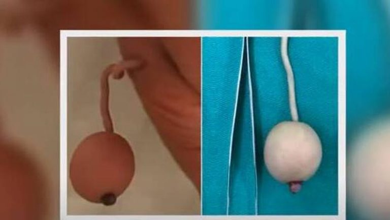 Μωράκι γεννήθηκε με ουρά 12 εκατοστών – Πώς το εξηγούν οι επιστήμονες