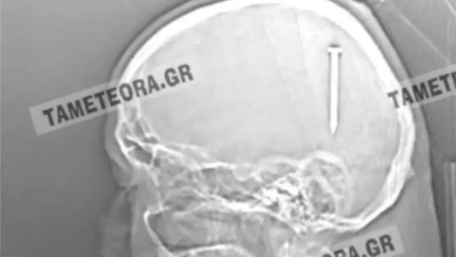 Καλαμπάκα: Καρφί 5 εκατοστών σφηνώθηκε στο κεφάλι άνδρα (εικόνες)
