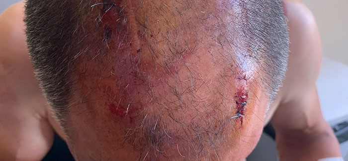 Άγριο περιστατικό ξυλοδαρμού στην Κρήτη - Του έστησαν ενέδρα και τον χτύπησαν στο κεφάλι (βίντεο)