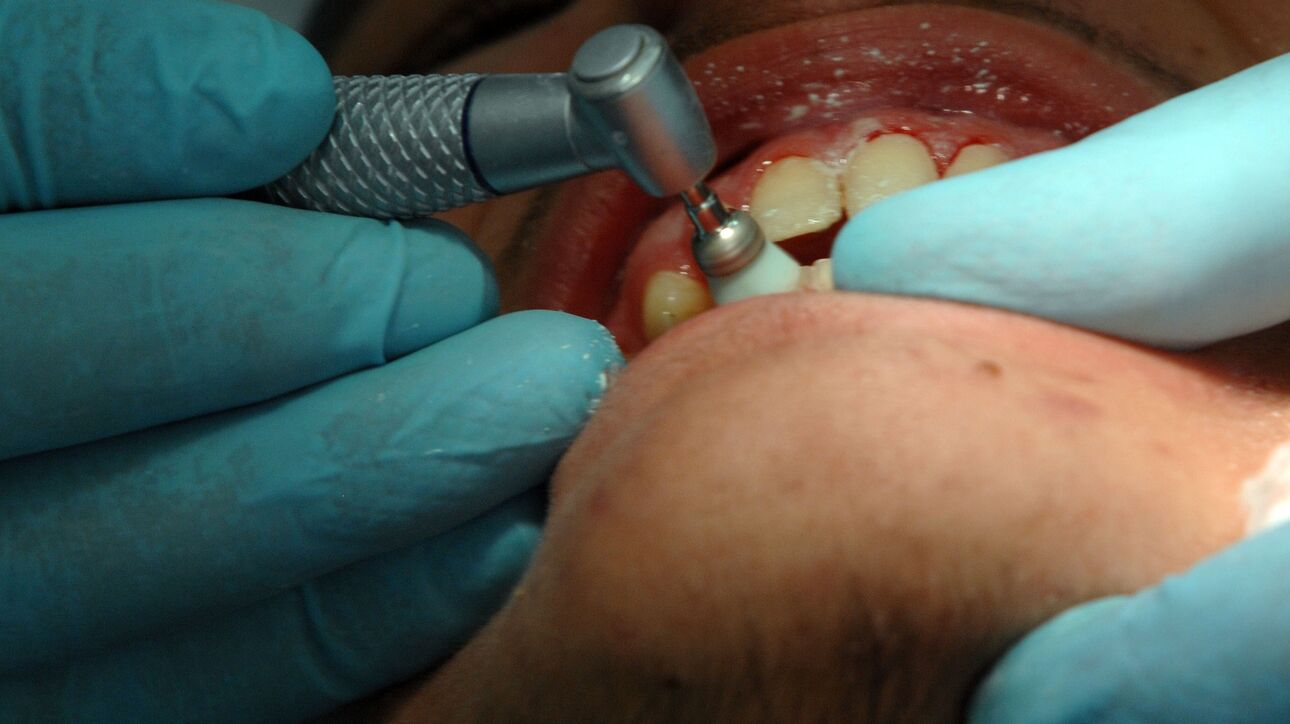 Dentist pass: Ξεκίνησε το πρόγραμμα για παιδιά 6-12 ετών – Πώς θα κάνετε αίτηση