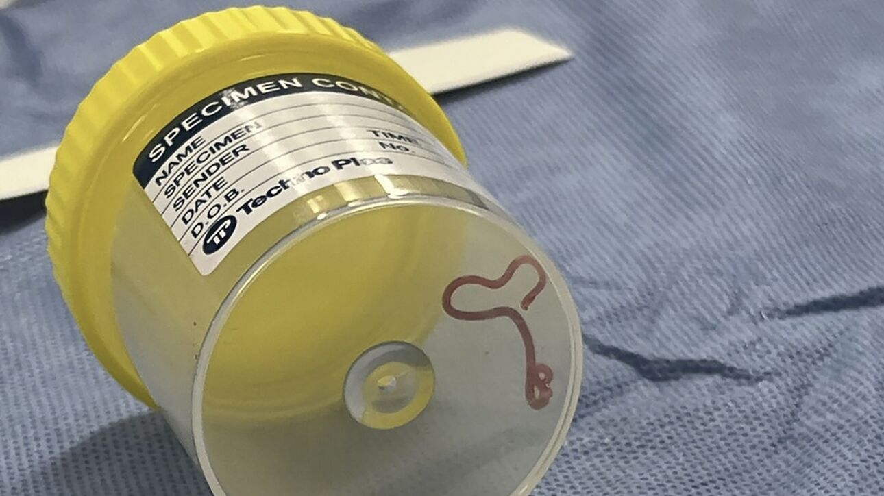 Ζωντανό σκουλήκι αφαιρέθηκε από εγκέφαλο γυναίκας στην Αυστραλία για πρώτη φορά στα χρονικά