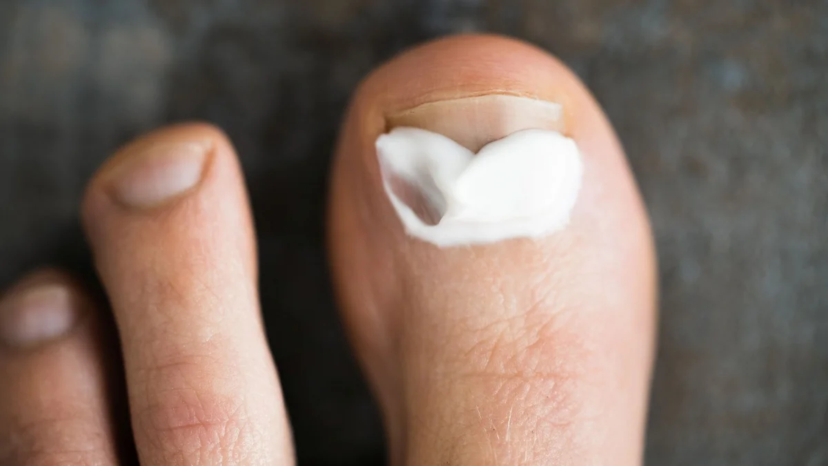 Γιατί δεν πρέπει να το παρακάνετε με τις αντιμυκητιασικές κρέμες