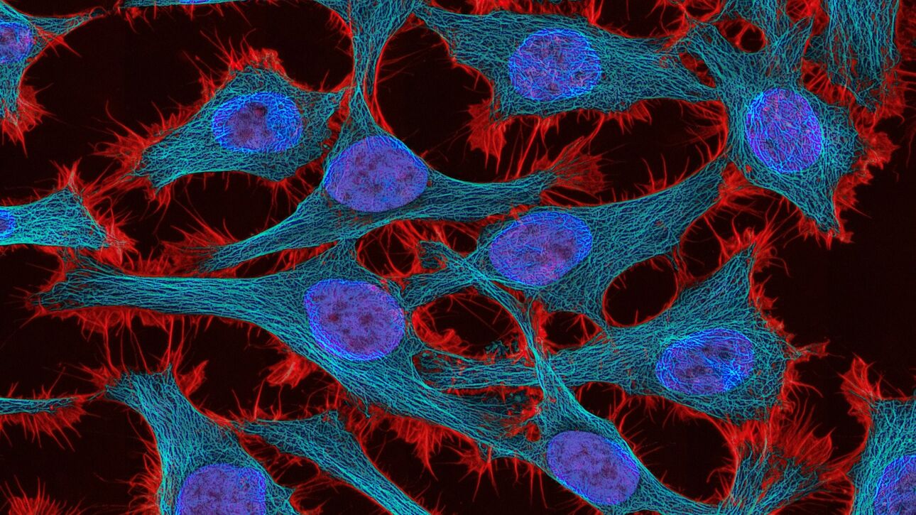 Η τεχνητή νοημοσύνη προβλέπει την ανταπόκριση του οργανισμού στη θεραπεία κατά του καρκίνου