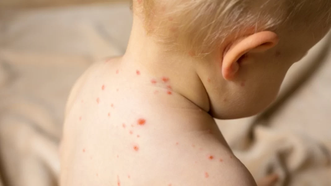 ΕΟΔΥ: Ανακοίνωσε οκτώ κρούσματα ιλαράς - Σύσταση για άμεσους εμβολιασμούς