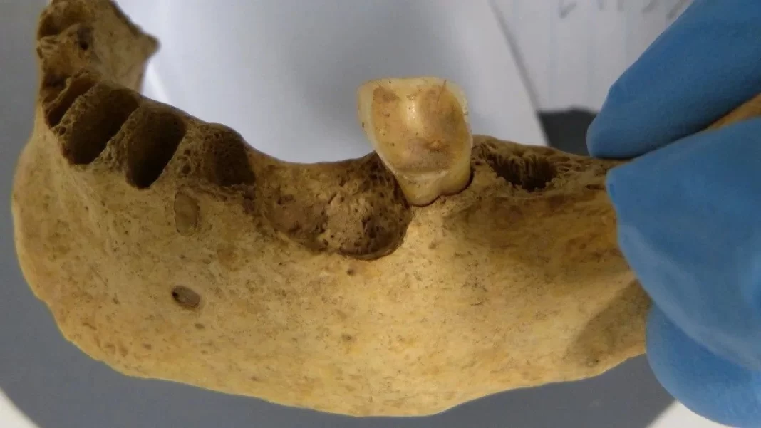 Βακτήρια σε δόντια 4.000 ετών αποκαλύπτουν στοιχεία για την τερηδόνα
