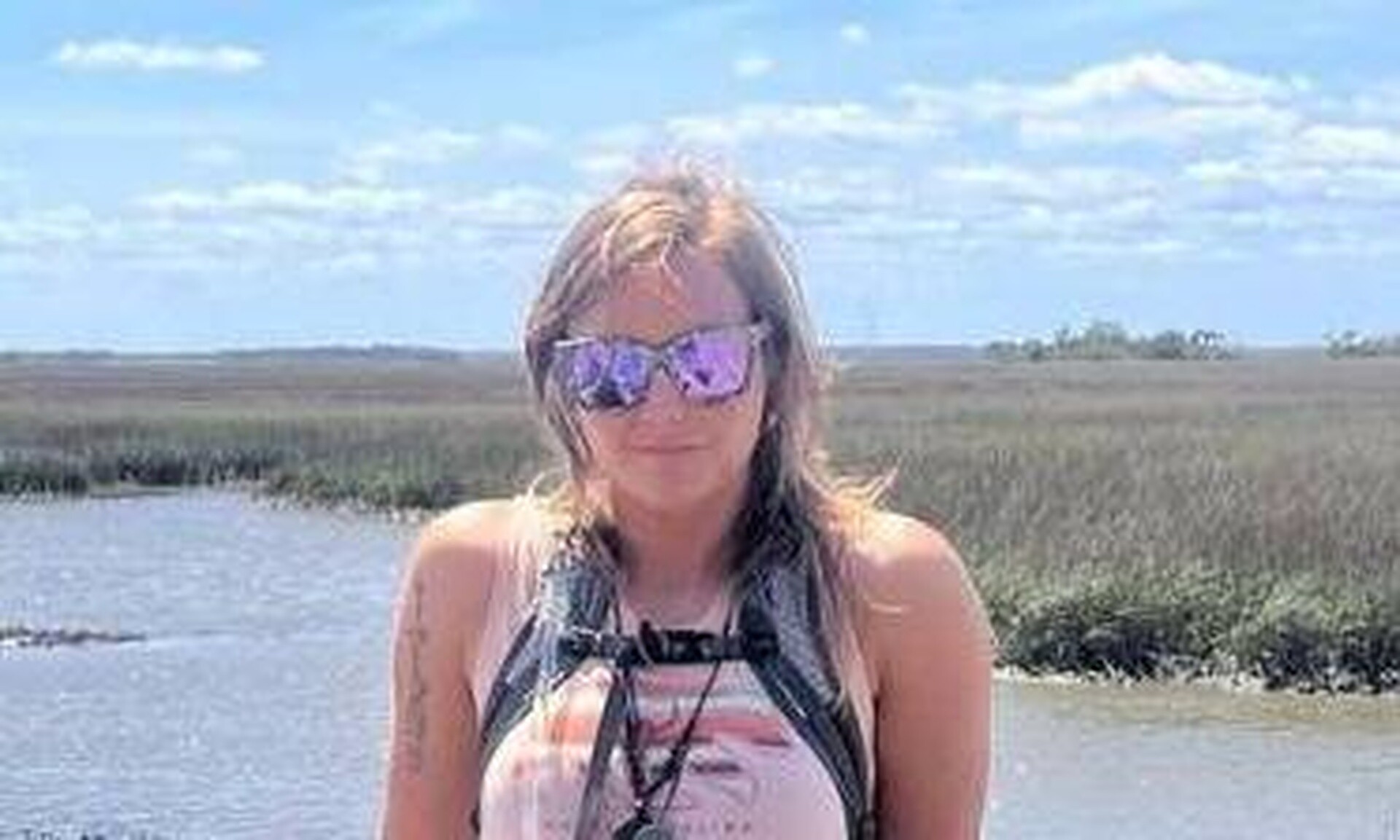 Σοκαριστικές εικόνες: Σπάνιο βακτήριο κατέστρεψε τα άκρα 24χρονης μετά από ατύχημα στο κολύμπι