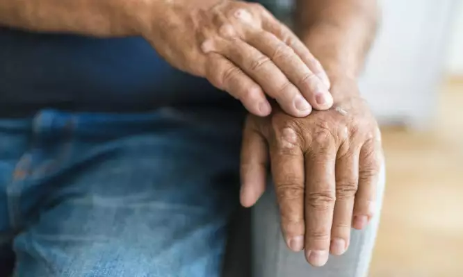 Υψηλά επίπεδα συμπτωμάτων αρθρίτιδας σε ασθενείς με ψωρίαση καταγράφει διεθνής μελέτη
