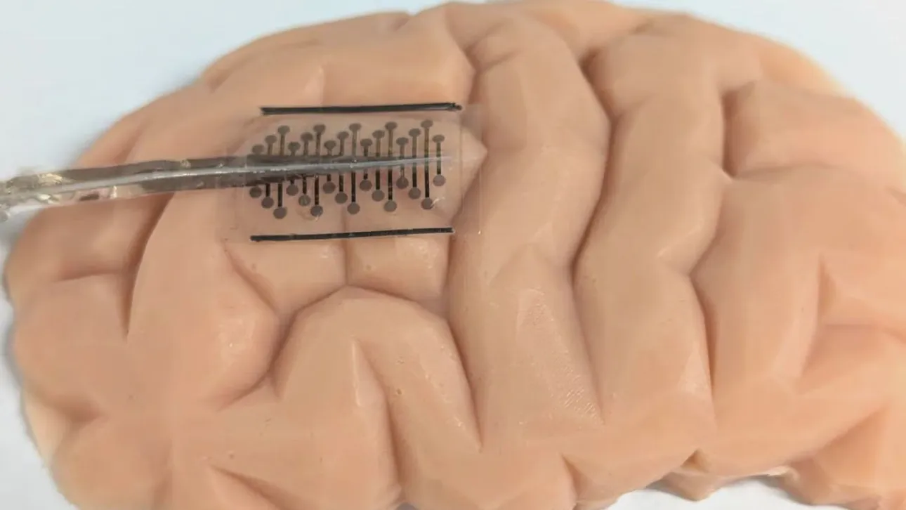 Εμφυτεύματα που ξεδιπλώνονται μέσα στον εγκέφαλο φέρνουν επανάσταση στη θεραπεία της επιληψίας