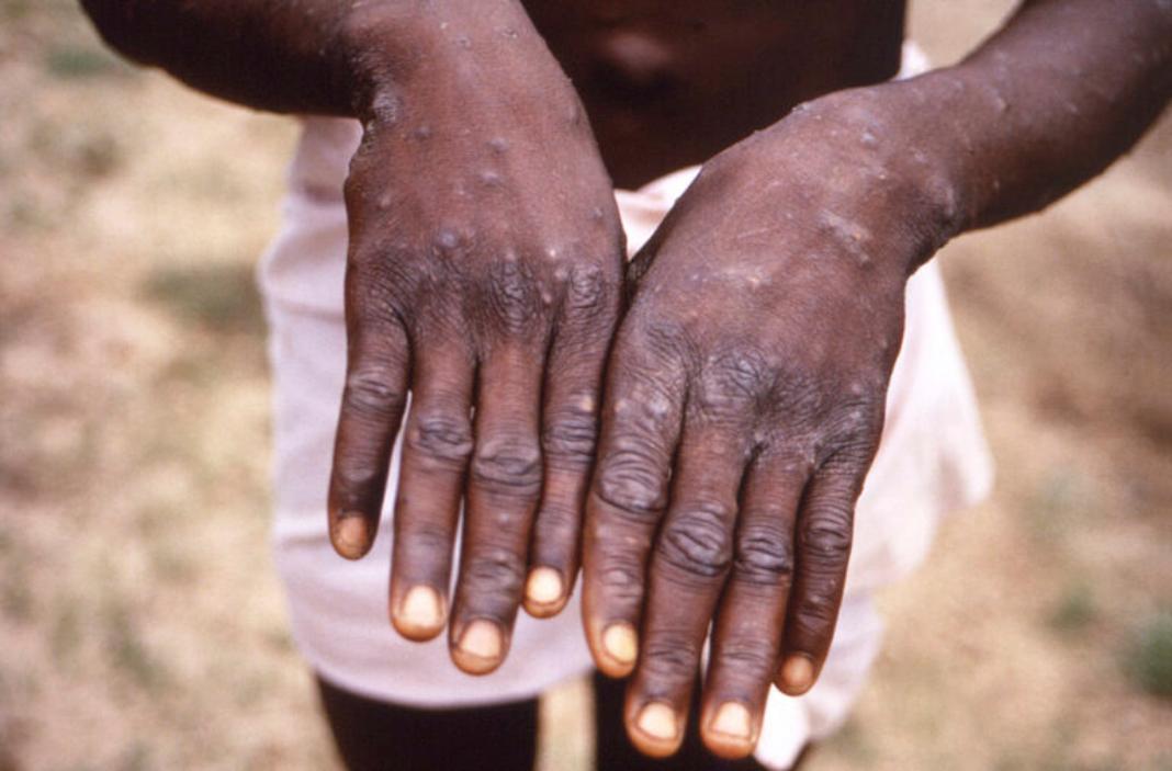 Mpox: Κρούει τον κώδωνα του κινδύνου ο ΠΟΥ – Ποιοι είναι οι λόγοι ανησυχίας