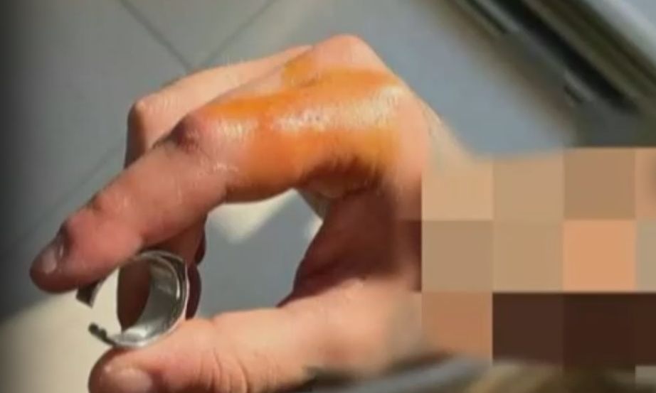 Φώναξαν ηλεκτρολόγο για να αφαιρέσει δαχτυλίδι από χέρι ασθενούς