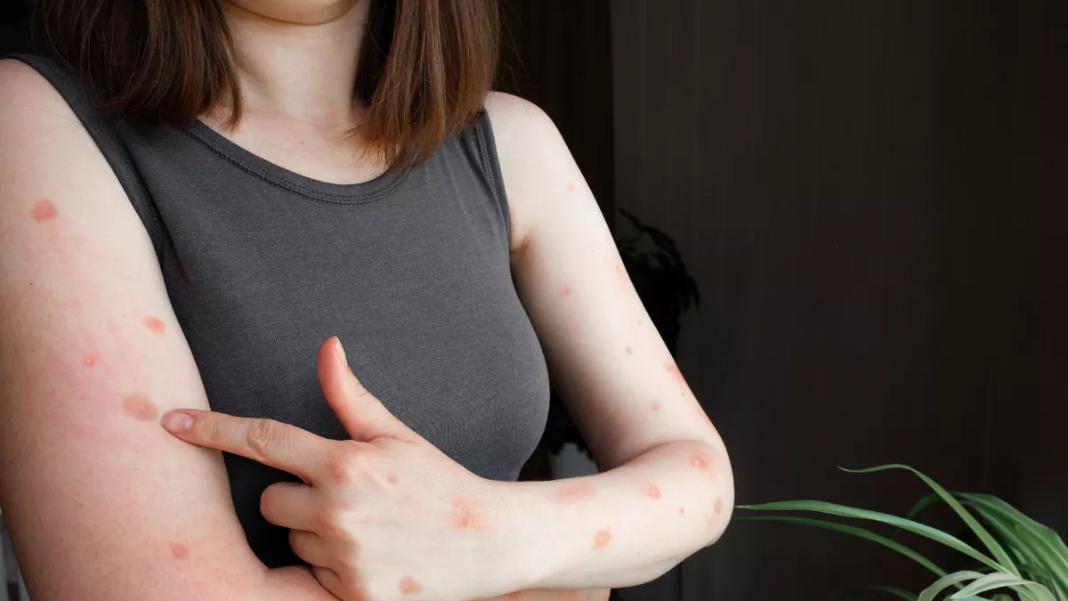 Ευλογιά των πιθήκων: Το νέο στέλεχος του ιού mpox θέτει σε συναγερμό όλο τον κόσμο