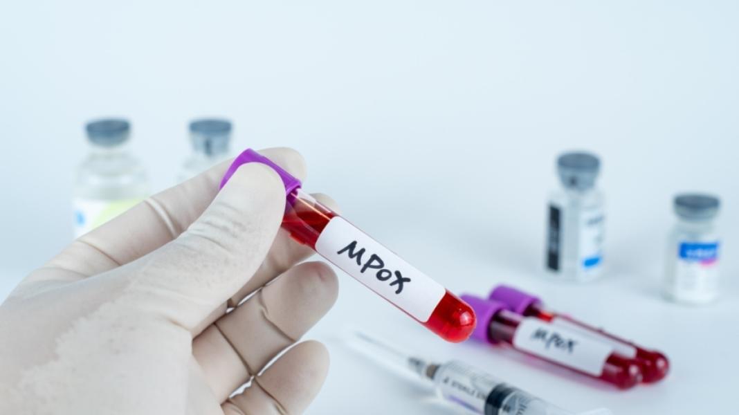 Mpox: 18 κρούσματα της ευλογιάς των πιθήκων το δίμηνο Νοεμβρίου – Δεκεμβρίου στην Ελλάδα