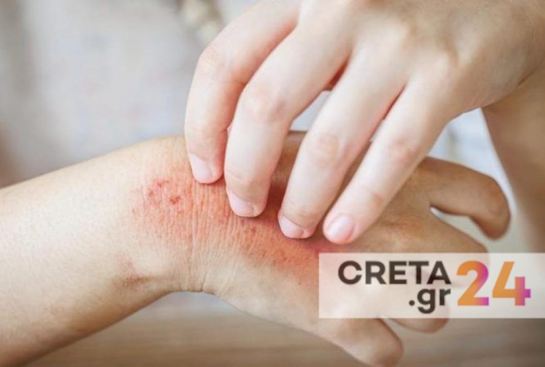 Κρούσματα ψώρας σε σχολείο του Ηρακλείου – Κινητοποίηση των υγειονομικών αρχών