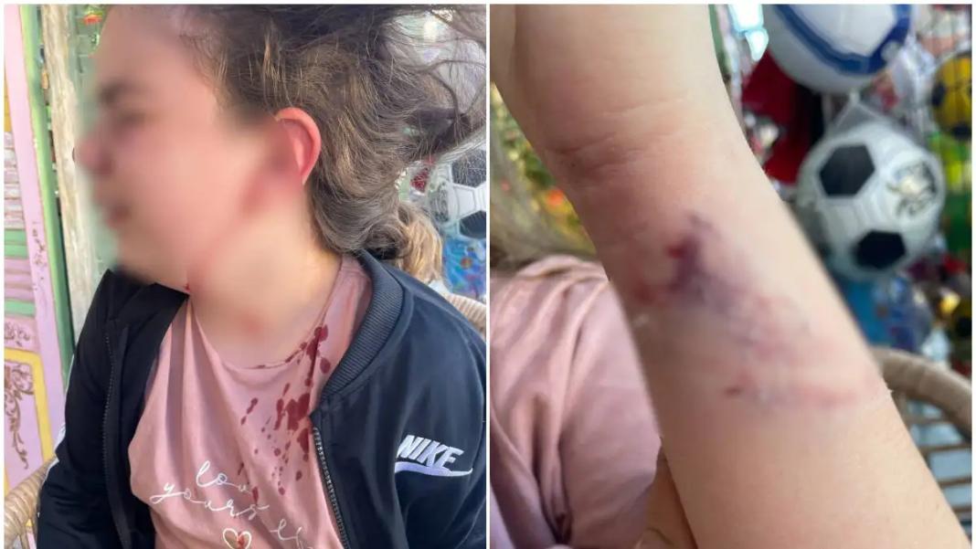 Άγρια επίθεση από αδέσποτο σκυλί σε 10χρονη – «Της όρμησέ και την έριξε κάτω», λέει η μητέρα της