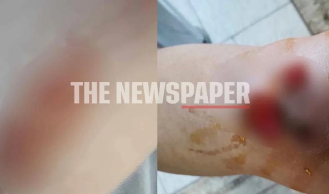 Αγέλη αδέσποτων κυνήγησε δικυκλίστρια – Έπεσε με σφορδότητα στο έδαφος, τραυματίστηκε και ήταν σε κατάσταση σοκ