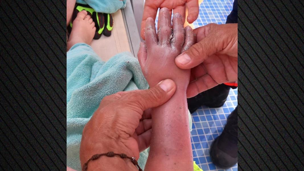 Στιγμές τρόμου σε ξενοδοχείο στη Μαγιόρκα: Σωλήνας ρούφηξε το χέρι 4χρονου