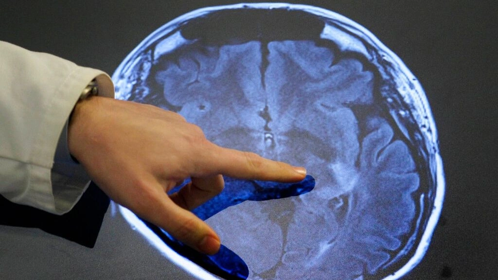 Μελέτη: Η υπερβολική κατανάλωση αλκοόλ συνδέεται με πρόωρα και σοβαρά εγκεφαλικά