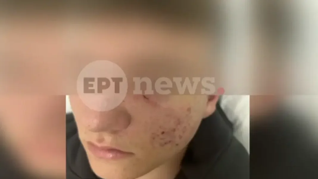 Ξάνθη: Έστησαν παγίδα και ξυλοκόπησαν 15χρονο