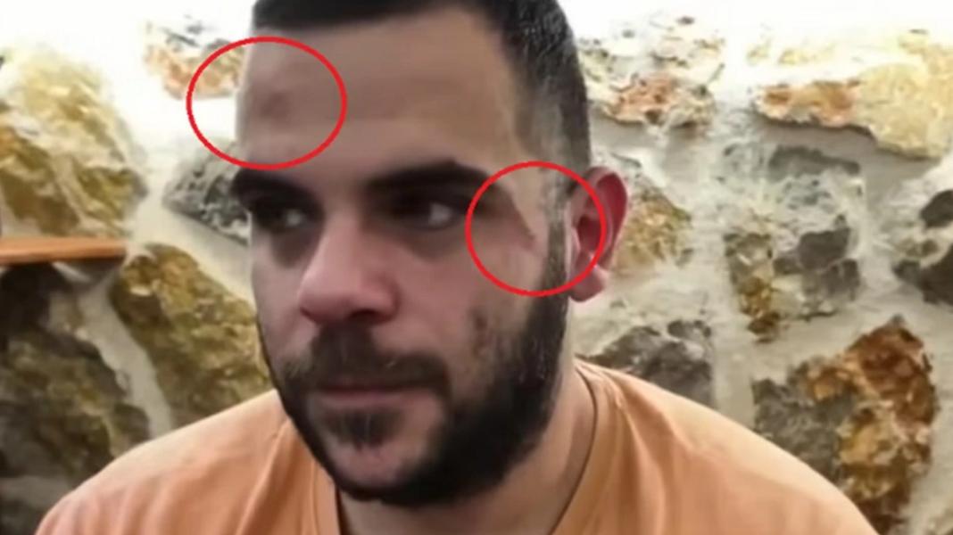 Ξυλοκόπησαν άγρια Youtuber σε live μετάδοση: Τον χτύπησαν σε σώμα και πρόσωπο, εμφανίστηκε με μελανιές – Δείτε βίντεο