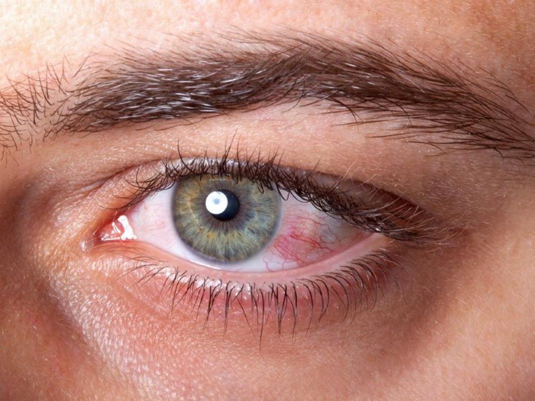 Όραση: Μην αγνοείτε την ξηροφθαλμία προειδοποιεί γιατρός του Χάρβαρντ – Τι να κάνετε