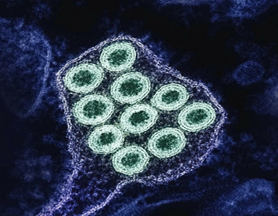 Η «υπεργρίπη» σαρώνει την Ευρώπη – Αυξάνεται η πίεση στα συστήματα υγείας προειδοποιεί ο ΠΟΥ